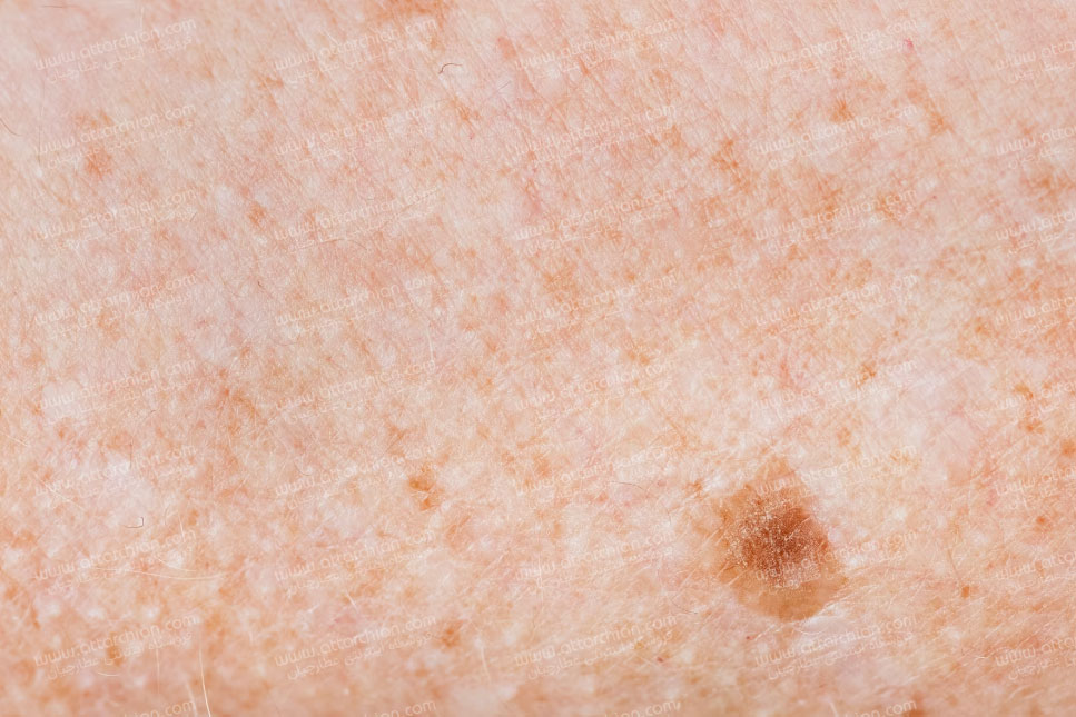 علت دون دون شدن پوست و ایجاد دانه های پوستی چیست؟